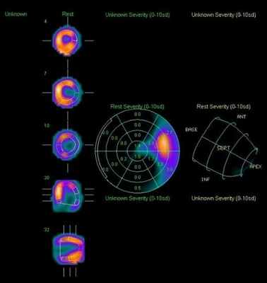 перфузионная сцинтиграфия миокарда