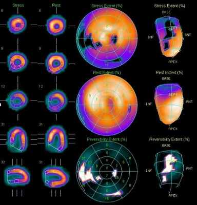 перфузионная сцинтиграфия с нагрузкой