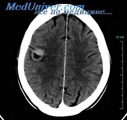 клиника субарахноидальной гематомы