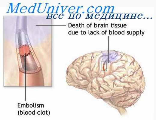 субарахноидальное кровоизлияние