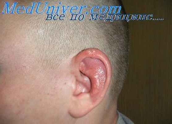 субъективные шумы в отоневрологии