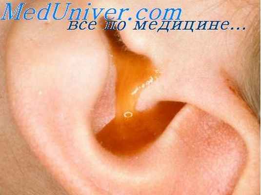 симптомы мастоидита