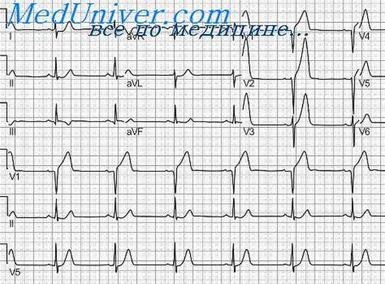 инфаркт миокарда