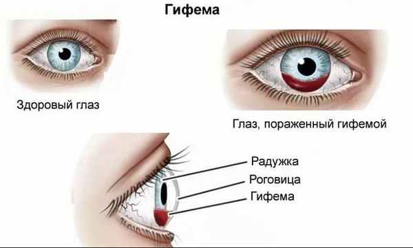 кровоизлияние внутри глаза