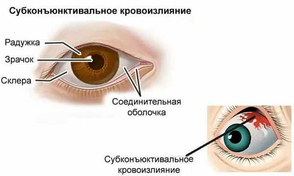 Субконъюнктивальное кровоизлияние глаза