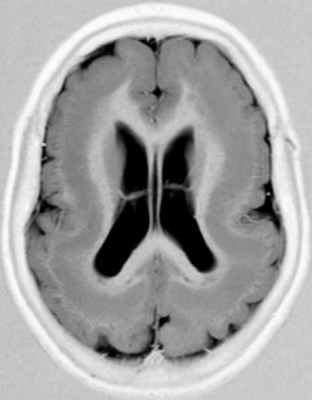 gband_heterotopia_fig2a