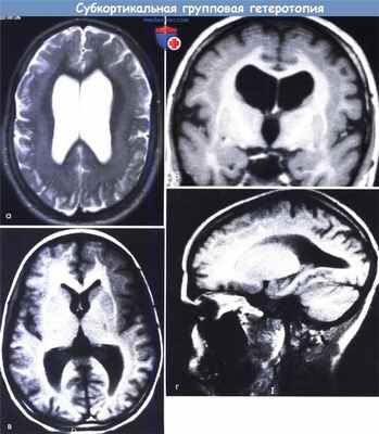 Субкортикальная групповая гетеротопия