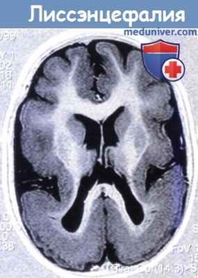 Лиссэнцефалия