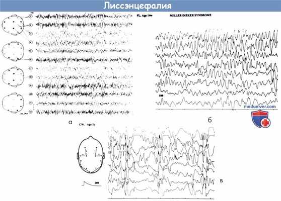 Лиссэнцефалия