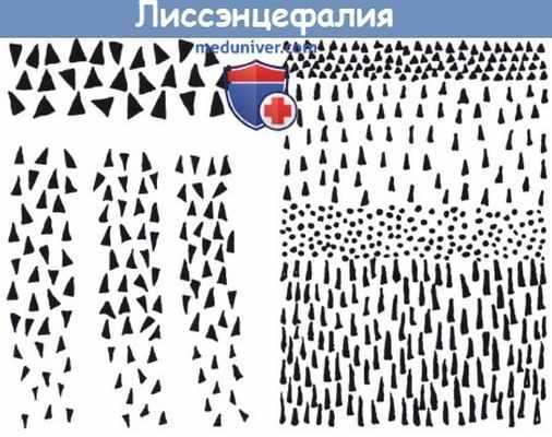 Лиссэнцефалия