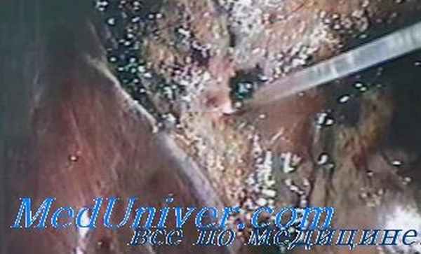 Субтотальная холецистэктомия. Частичная холецистэктомия. Холецистостомия.