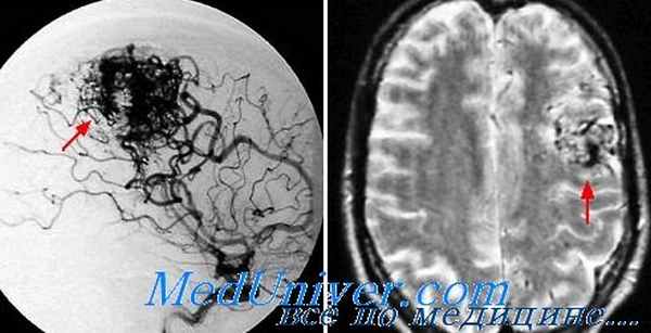 эпилепсия при артерио-венозных мальформациях