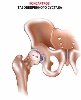 Коксартроз.jpg