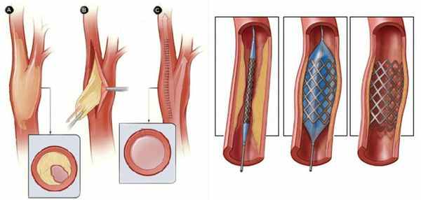 Удаление закупорки артерии/аутовенозное шунтирование