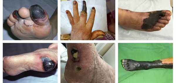 Виды сухой гангрены