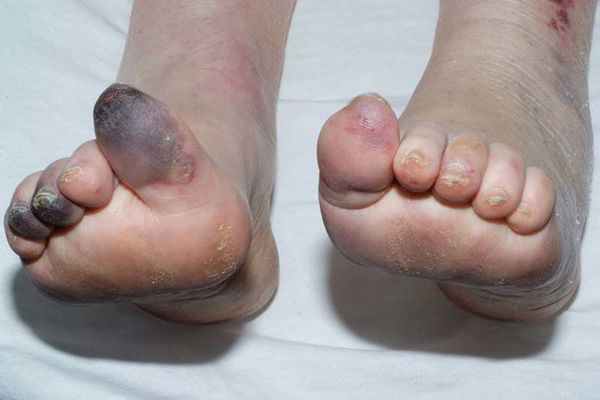 Некроз тканей