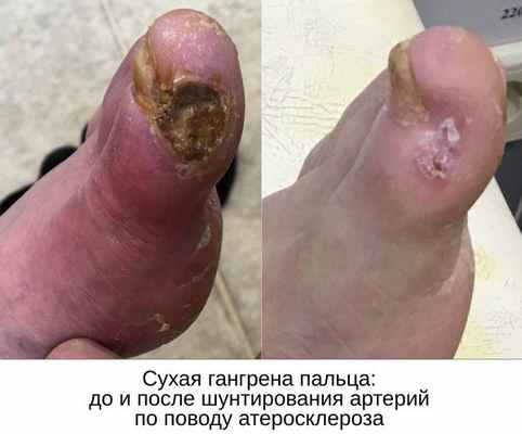 До и после шунтирования артерий