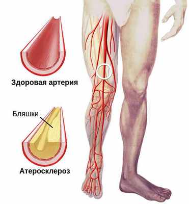 Артерия в норме и при атеросклерозе