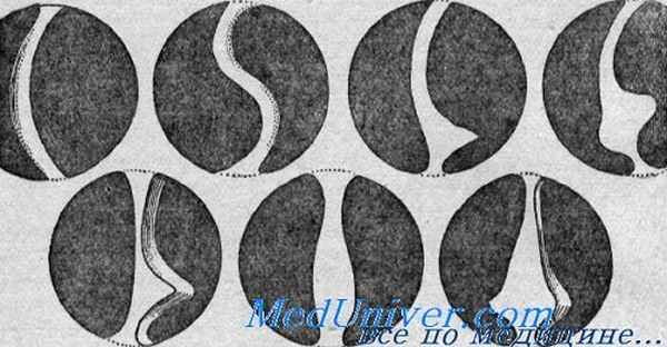 искривление носовой перегородки