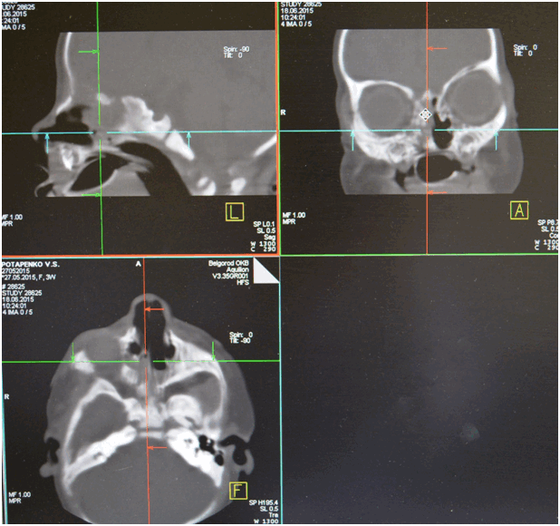 атрезия хоан