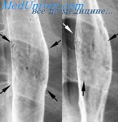 сужение просвета пищевода