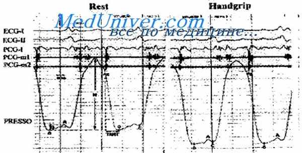 стеноз устья легочной артерии