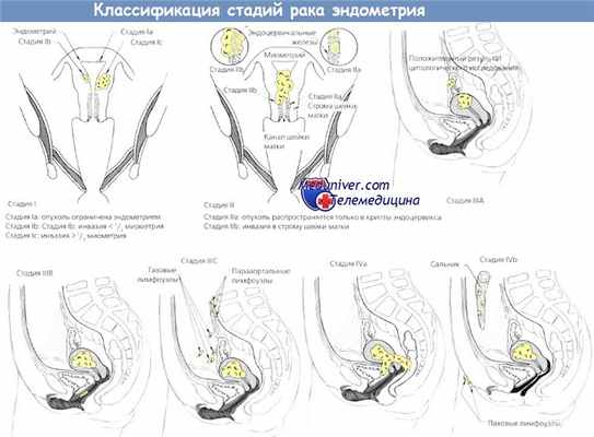 Классификация стадий рака эндометрия