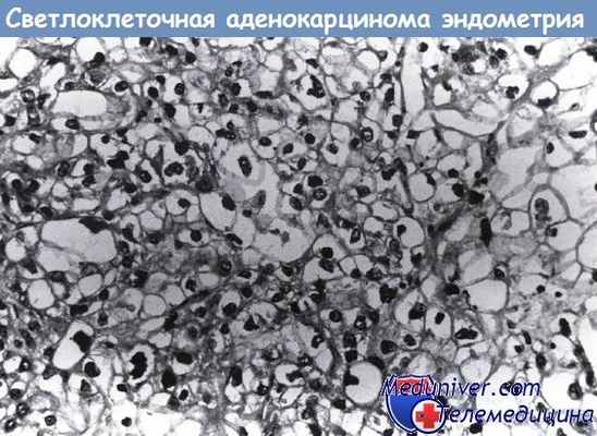 Светлоклеточная аденокарцинома эндометрия