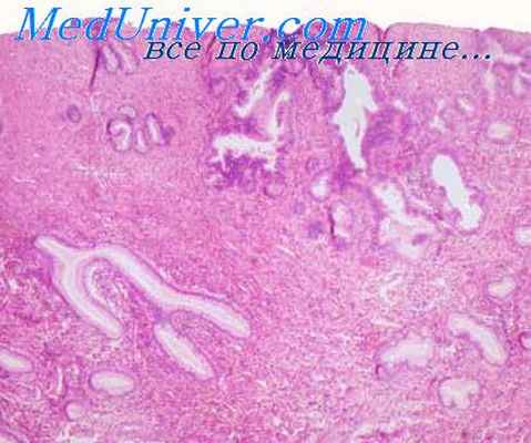 карцинома матки