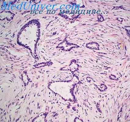 опухоли слюггых желез