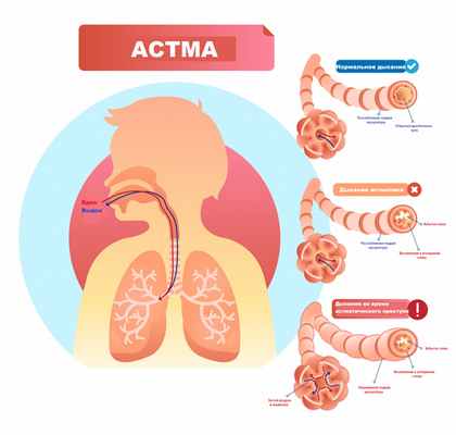 Астма.jpg