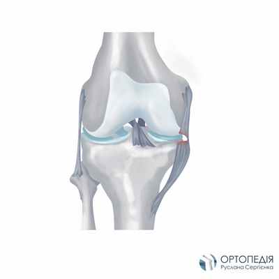 повреждение боковой свйзки колена_02.jpg