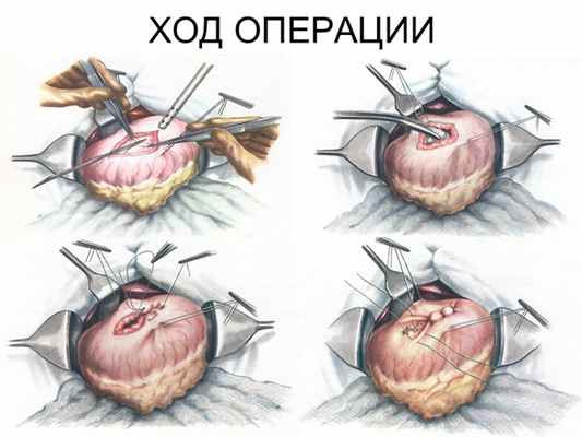 ХОД ОПЕРАЦИИ