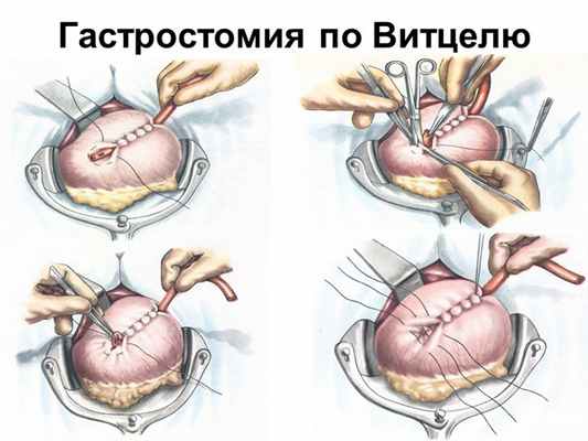 Гастростомия по Витцелю