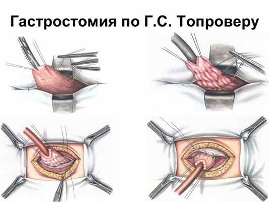 Гастростомия по Г.С. Топроверу