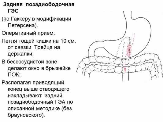 Задняя позадиободочная ГЭС (по Гаккеру в модификации Петерсена). Оперативн. 