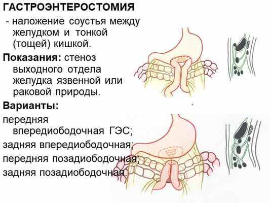 ГАСТРОЭНТЕРОСТОМИЯ - наложение соустья между желудком и тонкой (тощей) кишк. 