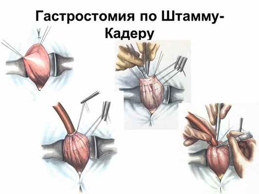Гастростомия по Штамму-Кадеру 