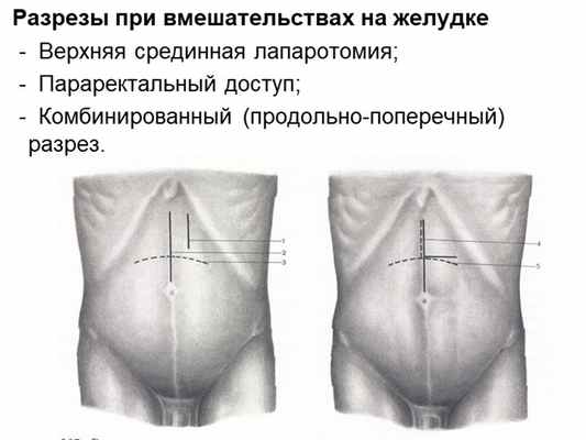 Разрезы при вмешательствах на желудке - Верхняя срединная лапаротомия;. 