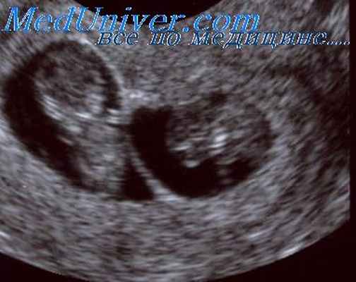 фето-фетальная трансфузия