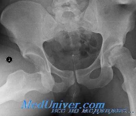 перелом вертлужной впадины