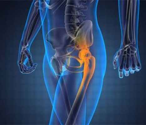 Остеосинтез вертлужной впадины в системе этапного лечения пострадавших с переломо-вывихами в области тазобедренного сустава