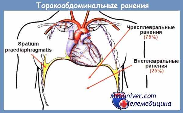 торакоабдоминальные ранения - сочетанные ранения груди и живота