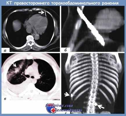 КТ торакоабдоминального ранения