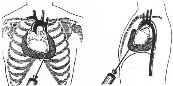 Пункция перикарда