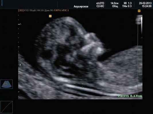 Нормальная носовая кость