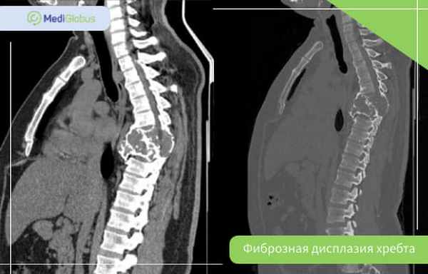 фиброзная дисплазия позвоночника кт лечение