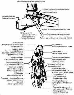 Варианты костной патологии стопы и голеностопного сустава
