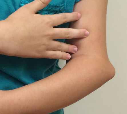 Удаление экзостозов