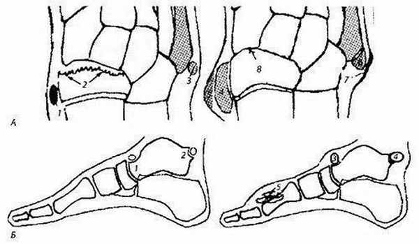 Локализация добавочных костей стопы и добавочных точек окостенения